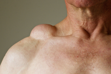 Lipoma Removal Surgery in Pune at Visarjini Clinic