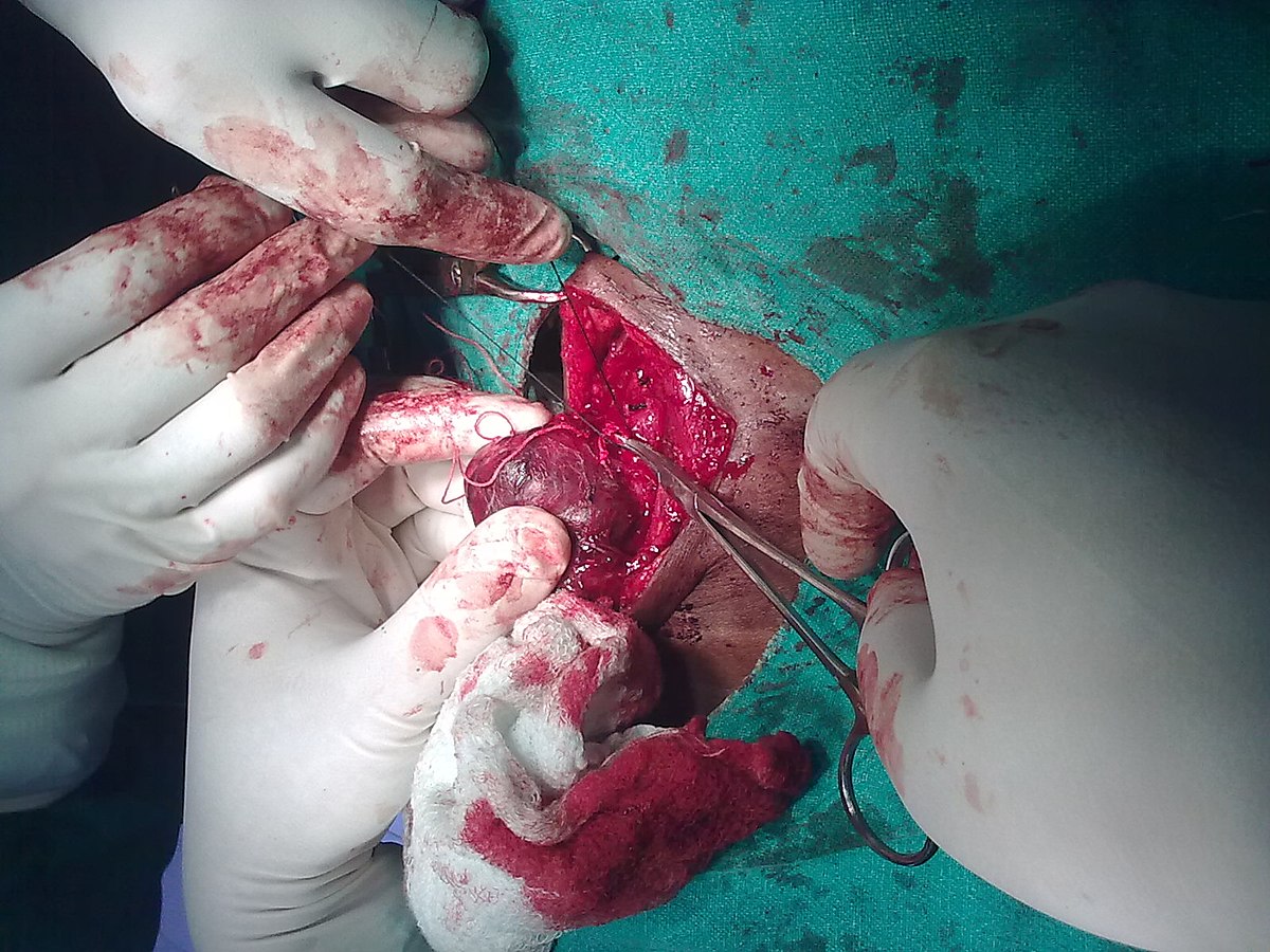 Thyroid Surgery in Pune