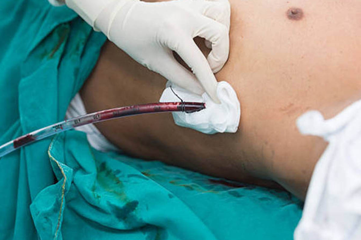 ICD Implantation in Pune