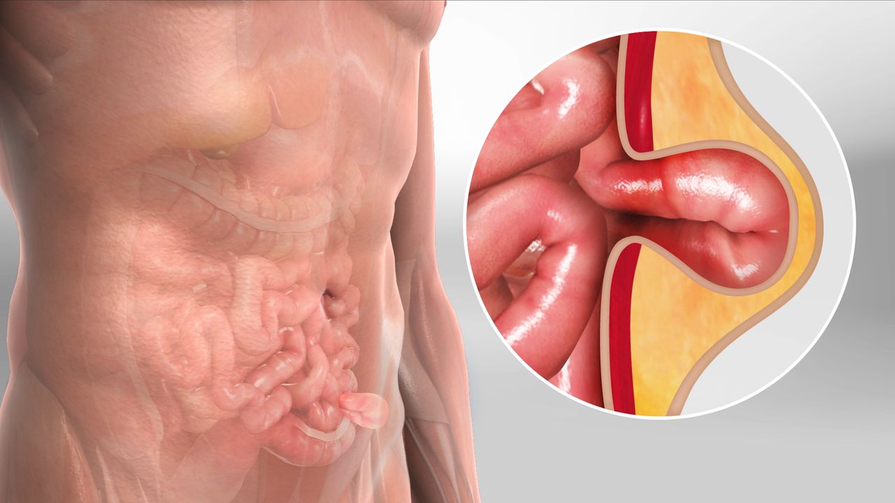 Incisional Hernia Repair Specialist in Pune Dr. Sandhya Bade