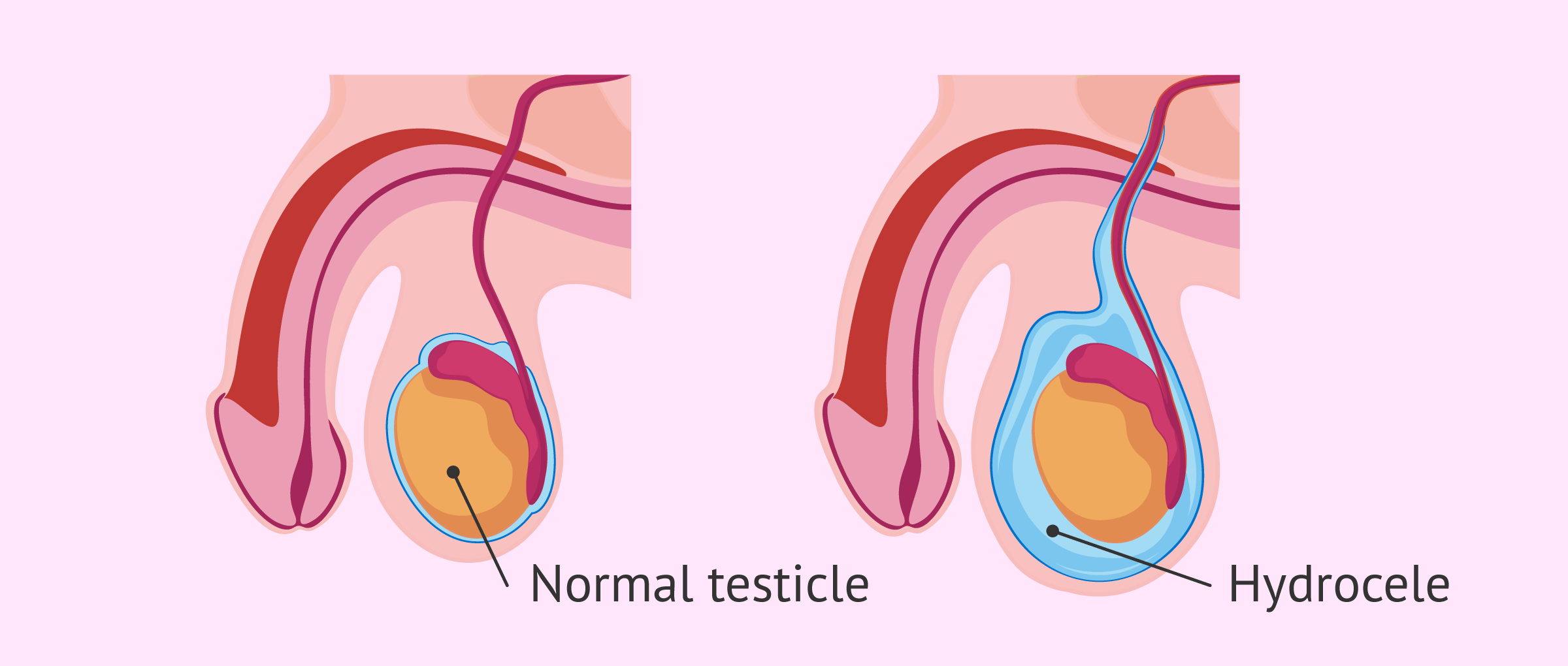 Painless Hydrocele Surgery in Pune