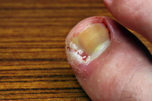 How to treat an ingrown toenail explained.