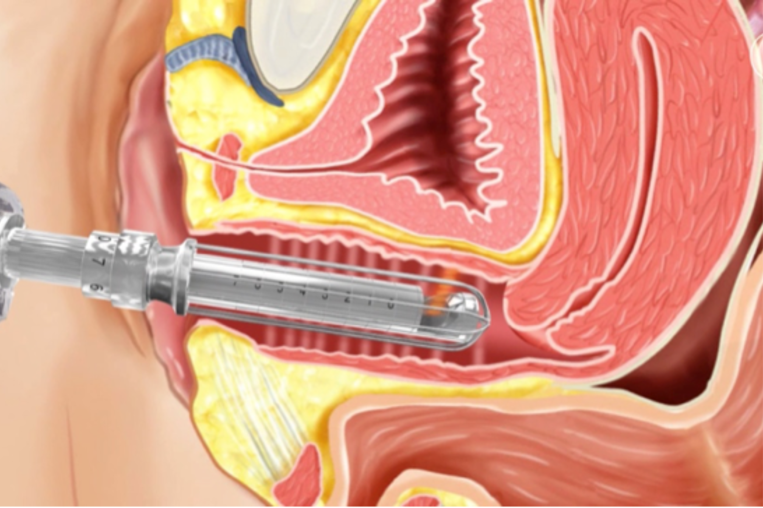 Find best Vaginal Tightening in Pune