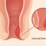Best Internal hemorrhoids treatment consultation with Dr. Sandhya Bade